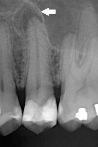 Digitales Röntgenbild eines Zahnes (zweiter Prämolar), der von chronischer apikaler Parodontitis (CAP) betroffen ist.